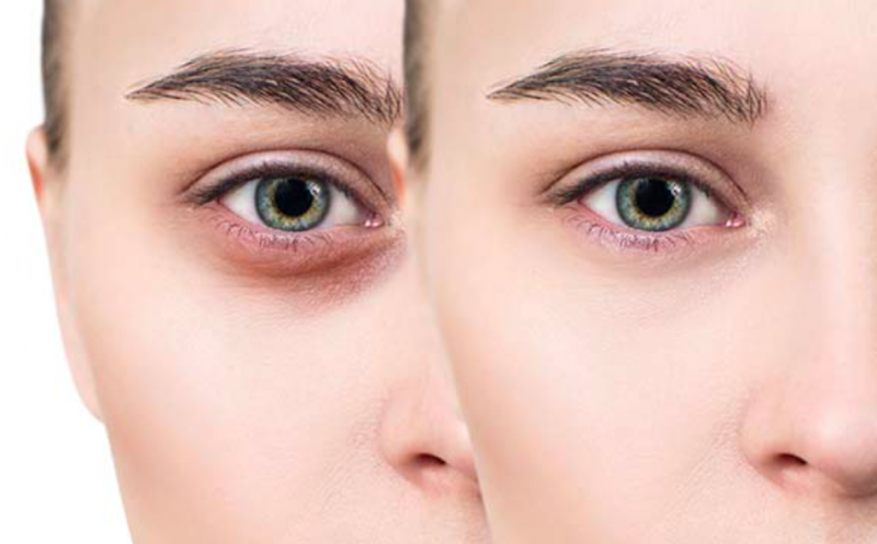 Eyes-dark-circles-panda eyes-improvement-methods-remove